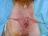 Labia Reduction Surgery (Labiaplasty)