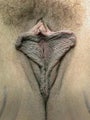 Labiaplasty