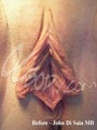 Labiaplasty before and after