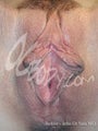 Labiaplasty before and after