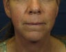 Laser Facelift
