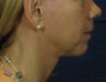 Laser Facelift