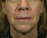 Laser Facelift