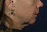 Laser Facelift