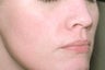 Laser Genesis for Overall Redness