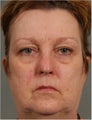 56 year old female treated for rosacea and facial spider veins