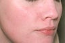 Laser Genesis for Overall Redness