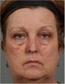 56 year old female treated for rosacea and facial spider veins