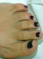Los Angeles Laser Hair Removal on the Feet
