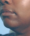 Dark Skin Laser Hair Removal Los Angeles