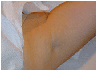 laser hair removal