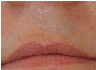 laser hair removal
