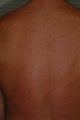 Laser Hair reduction on male back