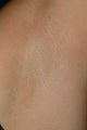 Laser underarm hair removal
