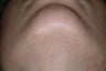 laser hair reduction