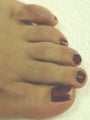 Los Angeles Laser Hair Removal on the Feet