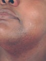 Dark Skin Laser Hair Removal Los Angeles