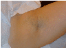 laser hair removal
