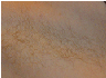 laser hair removal
