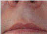 laser hair removal