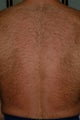 Laser Hair reduction on male back