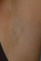 Laser underarm hair removal