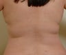 Laser assisted liposuction