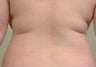 Laser assisted liposuction