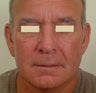 Rhinophyma-CO2 resurfacing