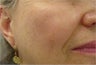 Sunspot freckle treatment