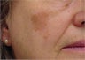 Sunspot freckle treatment