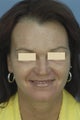 Fractionated CO2 Laser Resurfacing