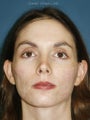 Full face erbium laser resurfacing