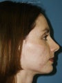 Full face erbium laser resurfacing