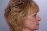 Laser Resurfacing