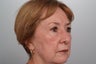 Fractionated CO2 laser resurfacing