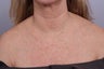 decollete laser resurfacing