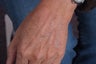 Fractionated CO2 laser resurfacing to hands