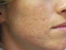 Acne Scars with Laser Resurfacing