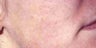Acne Scars with Laser Resurfacing