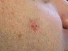 Acne scars treated with Punch Elevation of scars and Fractional Laser Resurfacing