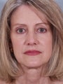 Woman wanting more youthful appearance