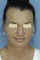 Fractionated CO2 Laser Resurfacing