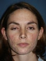 Full face erbium laser resurfacing