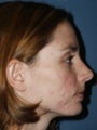 Full face erbium laser resurfacing