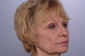 Laser Resurfacing