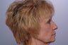 Laser Resurfacing