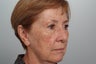 Fractionated CO2 laser resurfacing