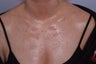 decollete laser resurfacing