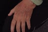 Fractionated CO2 laser resurfacing to hands